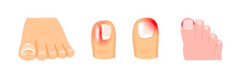 Podiatre ongle incarné : Quand consulter et comment le traiter ...
